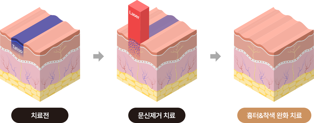 치료전 > 문신제거 치료 > 흉터&착색 완화 치료